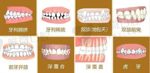各种牙套的区别（牙套是什么样子的）(图1)